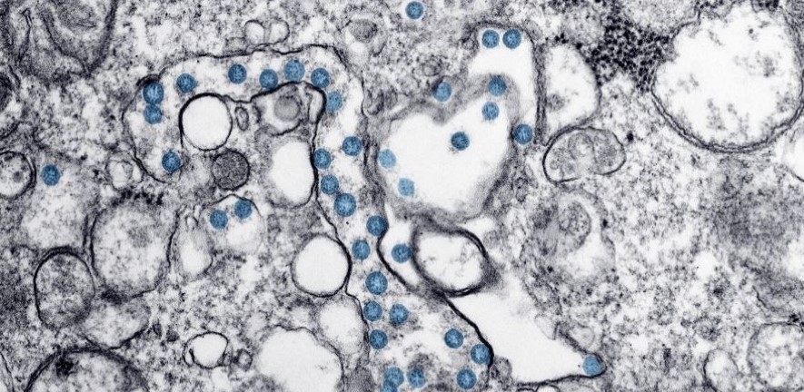 Image: Transmission electron microscopic image of an isolate from the first US case of COVID-19. Credit: CDC/ Hannah A Bullock; Azaibi Tamin. Image: Transmission electron microscopic image of an isolate from the first US case of COVID-19. Credit: CDC/ Hannah A Bullock; Azaibi Tamin.